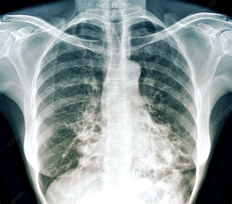 Bronchiectasis Chest X Ray