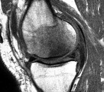 Subchondral Insufficiency Fracture of the Knee | Radsource