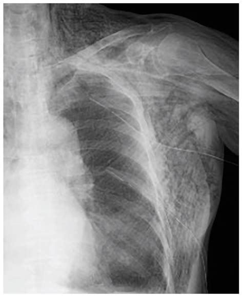 Medicina | Free Full-Text | A Case of Pneumothorax Ex Vacuo Associated ...