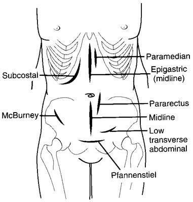 Abdominal Surgery: Different Types Of Abdominal Surgery