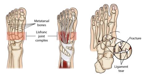 Lisfranc (Midfoot) Injury - OrthoInfo - AAOS