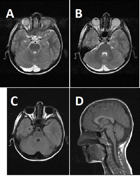 Is it an arachnoid cyst or a mega cisterna magna? What to and where to ...