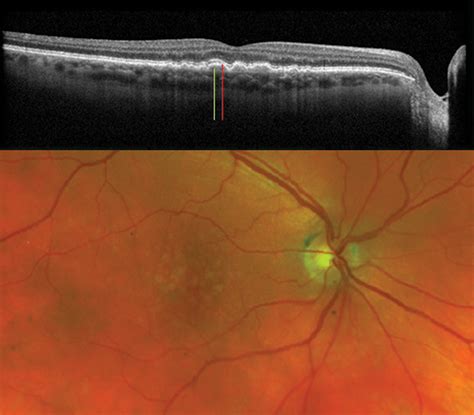 Take Macular OCT to a Whole New Layer