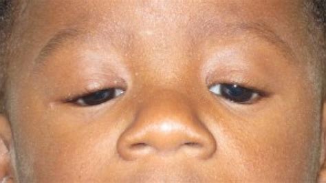 congenital ptosis| eyelid and orbital disorders