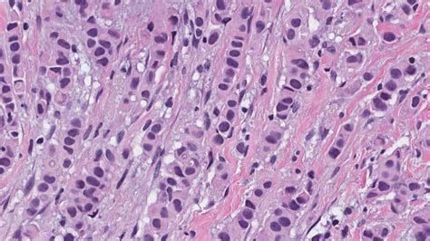 Invasive lobular carcinoma of the breast | Ottawa Atlas of Pathology