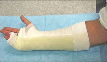 Principles of Casting and Splinting | AAFP