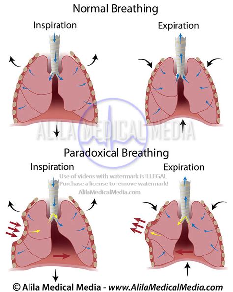 Alila Medical Media | Paradoxical breathing. | Medical illustration