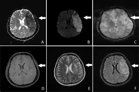 Cureus | Postpartum Ischemic Stroke: A Rare Case