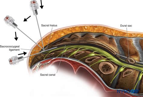 regional-anesthesia-caudal-approach-for-epidural-catheter-placement - NYSORA | NYSORA