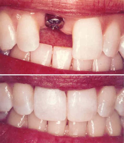 Single Tooth Implant Carmel, IN - Smiles in the Village Dentistry