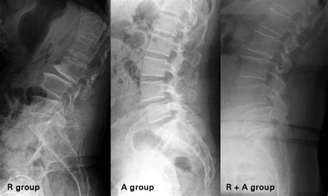 Retrolisthesis - Treatment, Causes, Symptoms, Definition