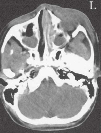 Axial CT image shows left-sided maxillary sinusitis with osteomyelitis... | Download Scientific ...