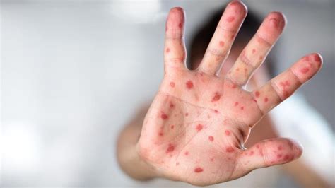 Rubella disease: German measles eliminated in Australia, says WHO | Daily Telegraph