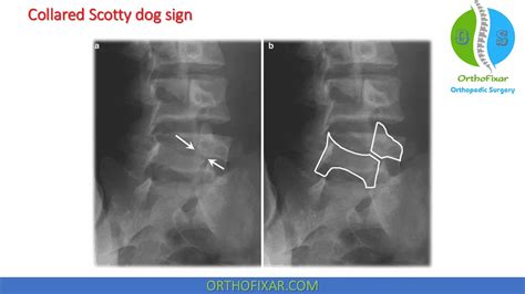 Spinal Spondylolysis | OrthoFixar 2024