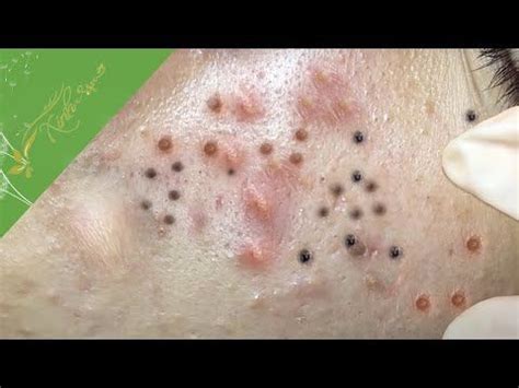 Make Your Day Relaxing with Xinh Spa 8#51 - YouTube in 2022 | Zit popping videos, Pimple popping ...