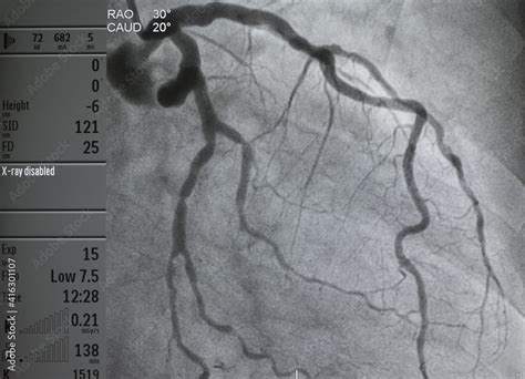 Coronary angiogram , medical x-ray for heart disease. Coronary artery disease. Stock Photo ...