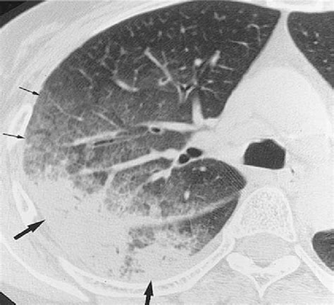 High resolution computed tomography of chronic eosinophilic pneumonia ...