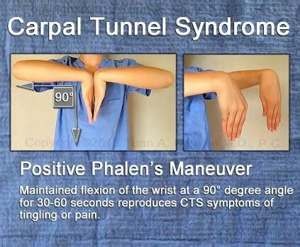 carpal tunnel syndrome Archives - PT Master Guide