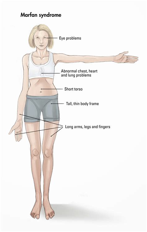 All About Marfan Syndrome: Daily Life with Marfan Syndrome