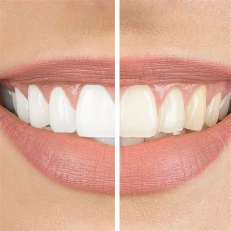 The Benefits of Choosing In-Office Professional Whitening Services at ...