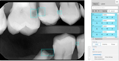 An example bitewing X-ray image with annotated carious lesions in the ...