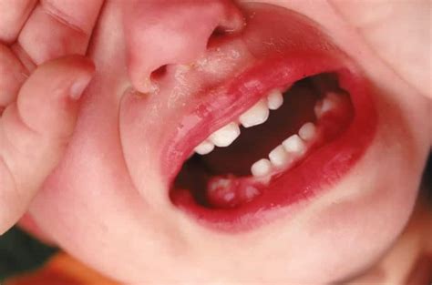 Enfermedades dentales en niños, cómo evitarlas | Madres Hoy