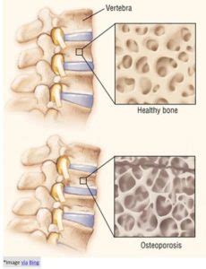 Osteopenia Risk factors, symptoms, signs, causes and Treatment