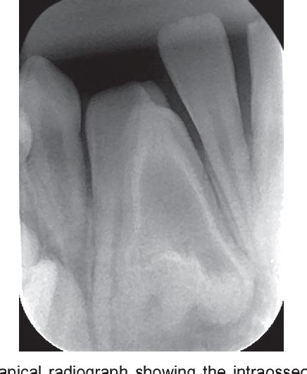 Figure 1 from A Rare Case of Radicular Dens in Dente diagnosed by Clinical, Radiographic ...