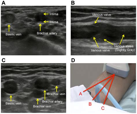 How to distinguish the artery and vein. (A) Typical appearance of... | Download Scientific Diagram