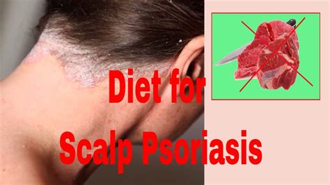 Diet for Scalp Psoriasis - YouTube