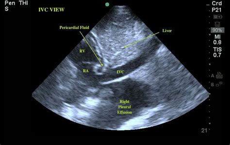 IVC View - Pericardial Effusion | Emory School of Medicine