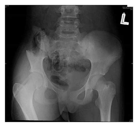 X-ray image of the patient showing right internal hemipelvectomy ...