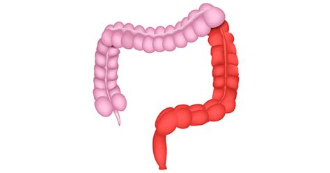 Left-sided (distal) colitis | IBDrelief