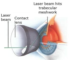 Selective Laser Trabeculoplasty (SLT) – The Royal Victorian Eye and Ear Hospital