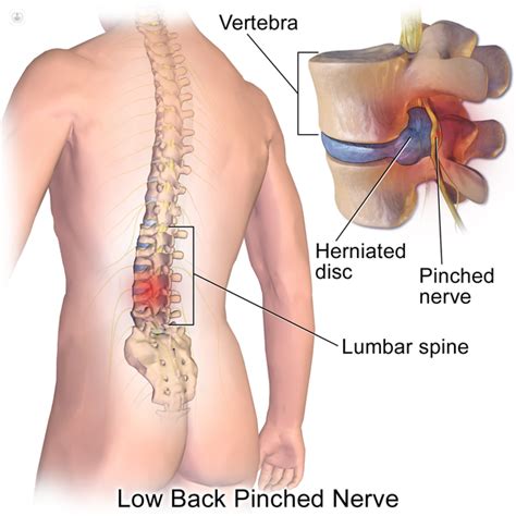 Slipped disc: what is it, symptoms and treatment | Top Doctors