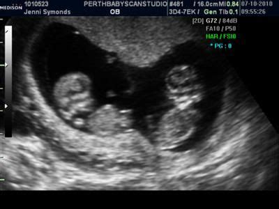 Baby Ultrasound Pictures 10 Weeks | admohwa