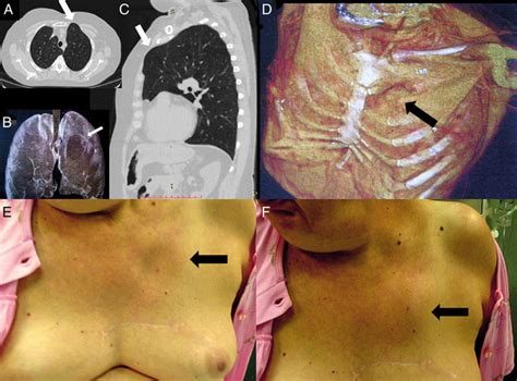 (A) Chest computed tomography axial view showing anterior hernia of the... | Download Scientific ...