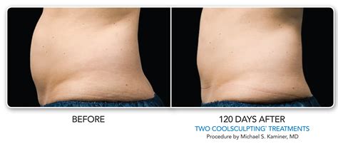 CoolSculpting Before & After Photos | Dermatology Consultants