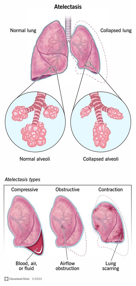 Atelectasis: Causes, Symptoms, Diagnosis & Treatment