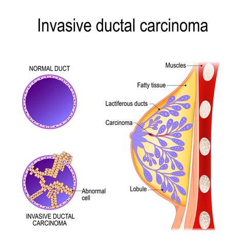 Invasive Breast Cancers | ACS