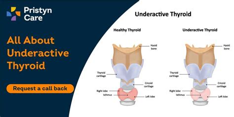 Underactive Thyroid (Hypothyroidism) - Pristyn Care