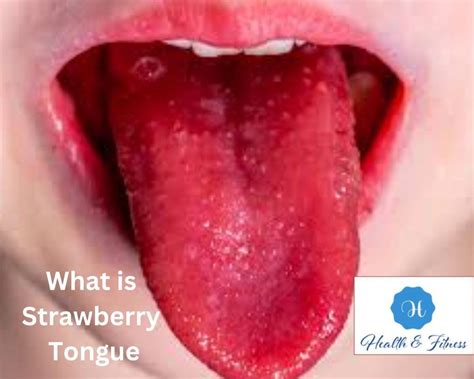 What Is Strawberry Tongue: From Causes To Treatment