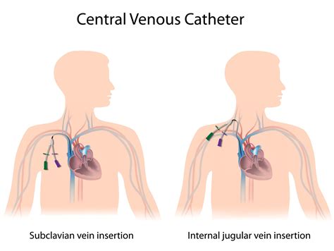 Central Venous Catheter Subclavian