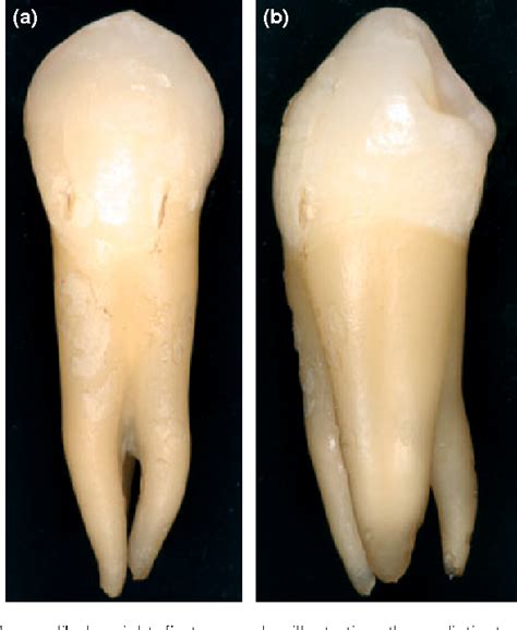 Anomalous mandibular premolars: a mandibular first premolar with three ...