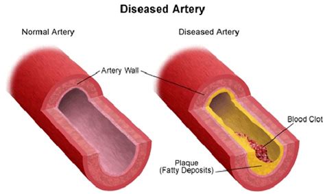 Vascular Disease Causes | Stanford Health Care