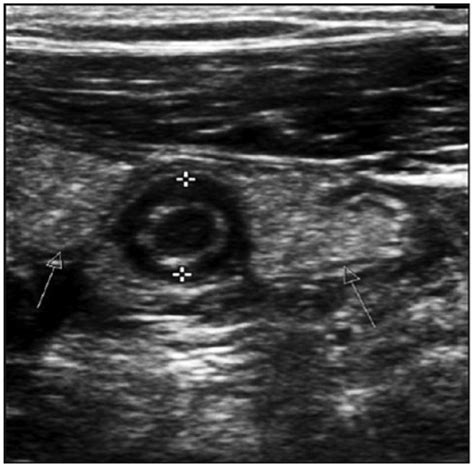 Appendicitis Ultrasound Criteria