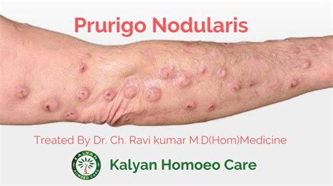 Best Homeopathy Treatment & Medicine For Prurigo Nodularis |Dr ...