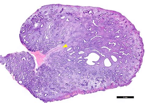 Fibroepithelial Polyp Histology