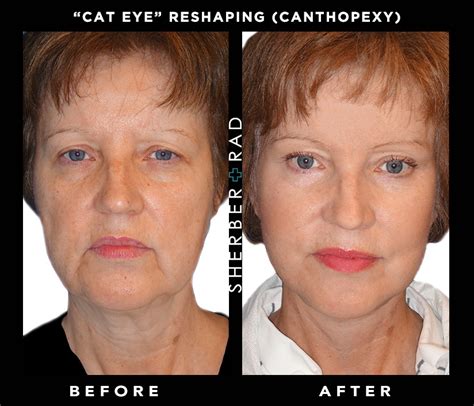 Cat Eye Reshaping Washington DC | Canthopexy Northern VA