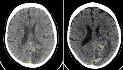 Haemorrhagic transformation of CVA - Radiology at St. Vincent's University Hospital